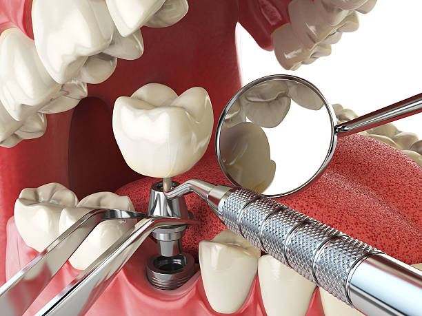 Best Broken or Chipped Tooth Repair in Vienna, GA
